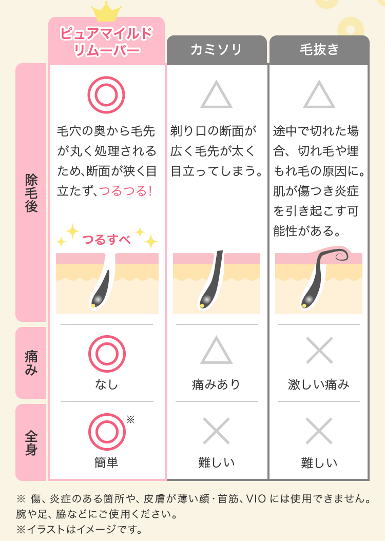 ピュアマイルドリムーバー 除毛後|毛穴の奥から毛穴が丸く処理されるため、断面が狭く目立たず、つるつる！ 痛み|なし 全身|簡単 カミソリ 除毛後|剃り口の断面が広く毛先が太く目立ってしまう。 痛み|あり 全身|難しい 毛抜き 除毛後|途中で切れた場合、切れ毛や埋もれ毛の原因に。肌が傷つき炎症を引き起こす可能性がある。 痛み|激しい痛み 全身|難しい