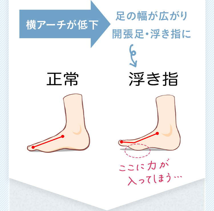 横アーチが低下 足の幅が広がり開張足・浮き指に